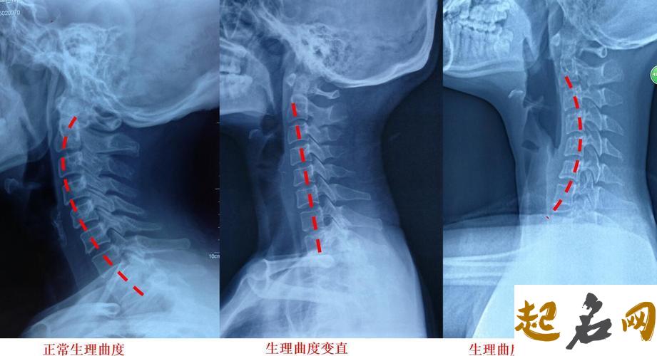 剑锋金命遇上反弓路该如何化解？ 颈椎反弓是什么意思