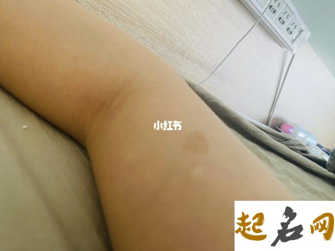 梦见胳膊打针变色是什么意思【好不好】 右胳膊有胎记