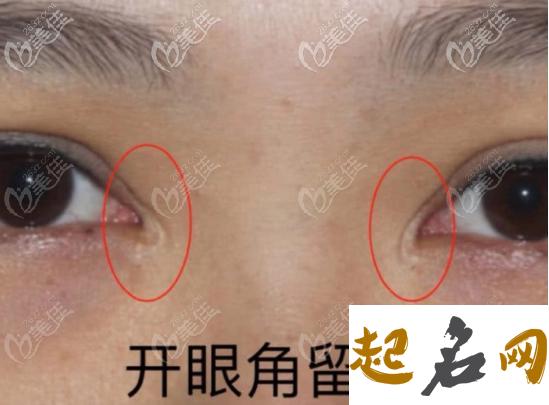 眼角有疤痕的男人运势如何 人缘运势不好 双眼皮开眼角疤痕增生